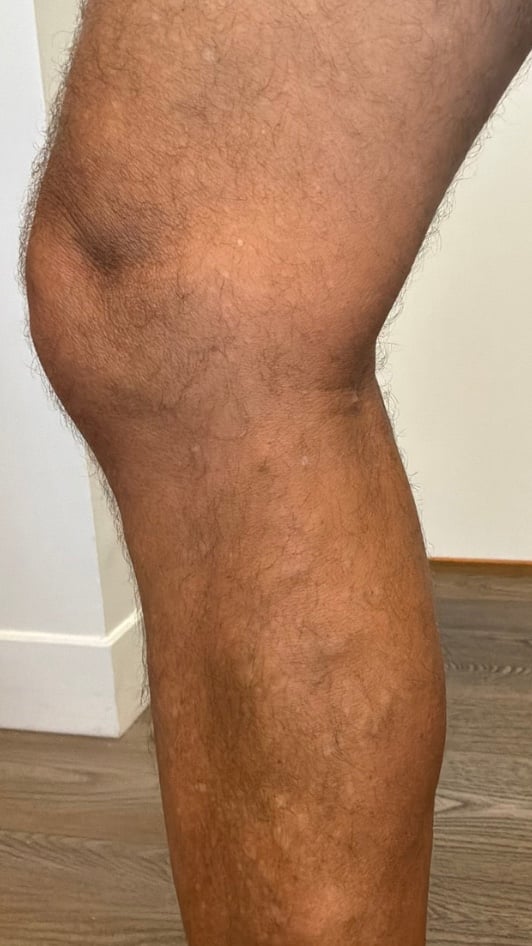 Leg below the knee after varicose vein treatment