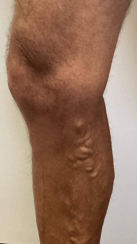 Varicose vein cluster below the knee before treatment