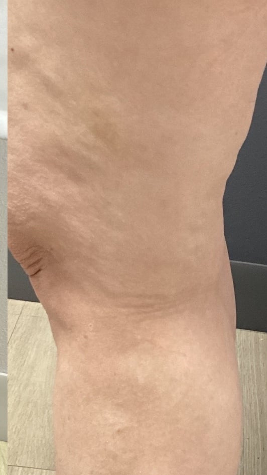 Knee and lower thigh after varicose vein treatment