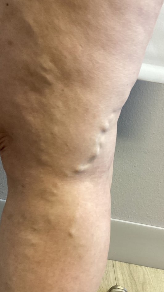 Bulging varicose veins above the knee before treatment